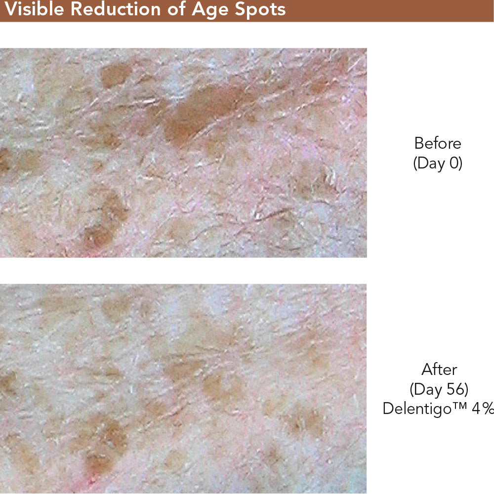 Before-and-after skin comparison showing visible reduction of age spots over 56 days, with close-up texture images labeled 'Before (Day 0)' and 'After (Day 56) Delentigo 4%'.